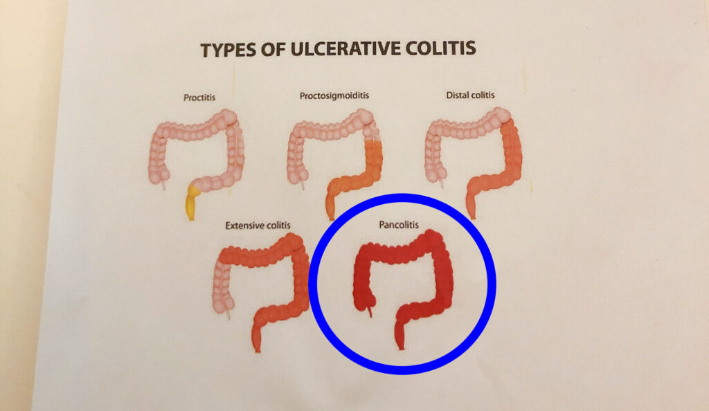 Ulcerative_colitis